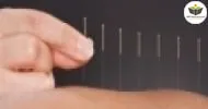 Curso de INTRODUÇÃO EM ACUPUNTURA